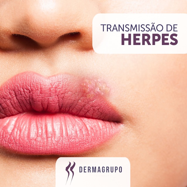 Herpes simples